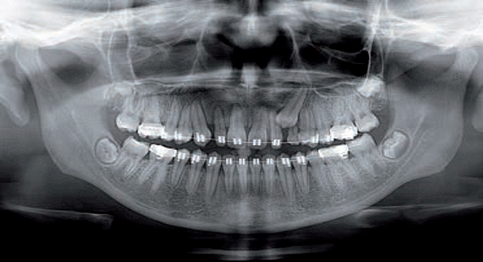 рентгеновский снимок зуба фото